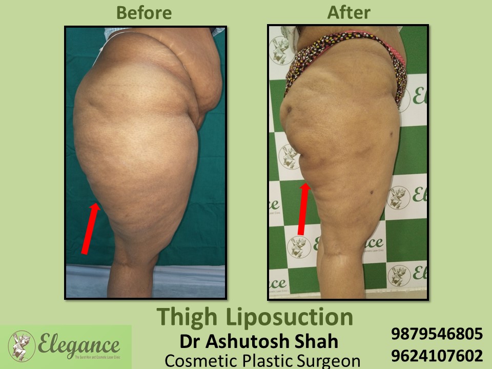 Liposuction-Low Cost Body Fat Reduction Treatment In Bardoli, Ankleshwar,  Vadodara.