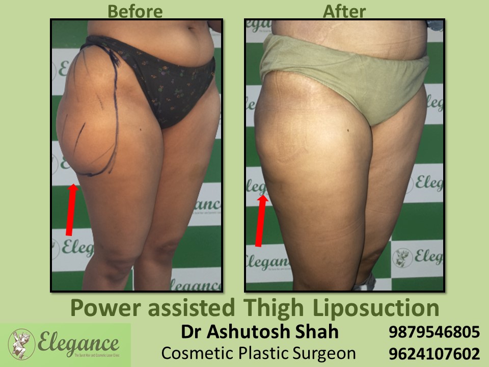 Liposuction-Low Cost Body Fat Removal Treatment In Surat, Vapi, Bharuch.