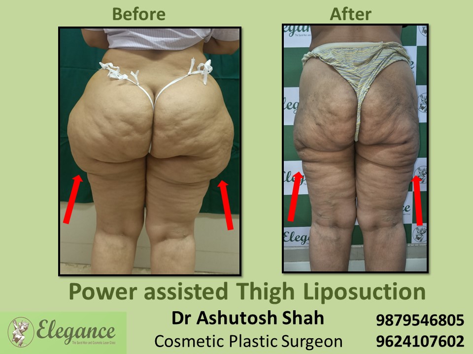 Liposuction-Thigh Extra Fat Removal Treatment In Surat, Vapi, Valsad.