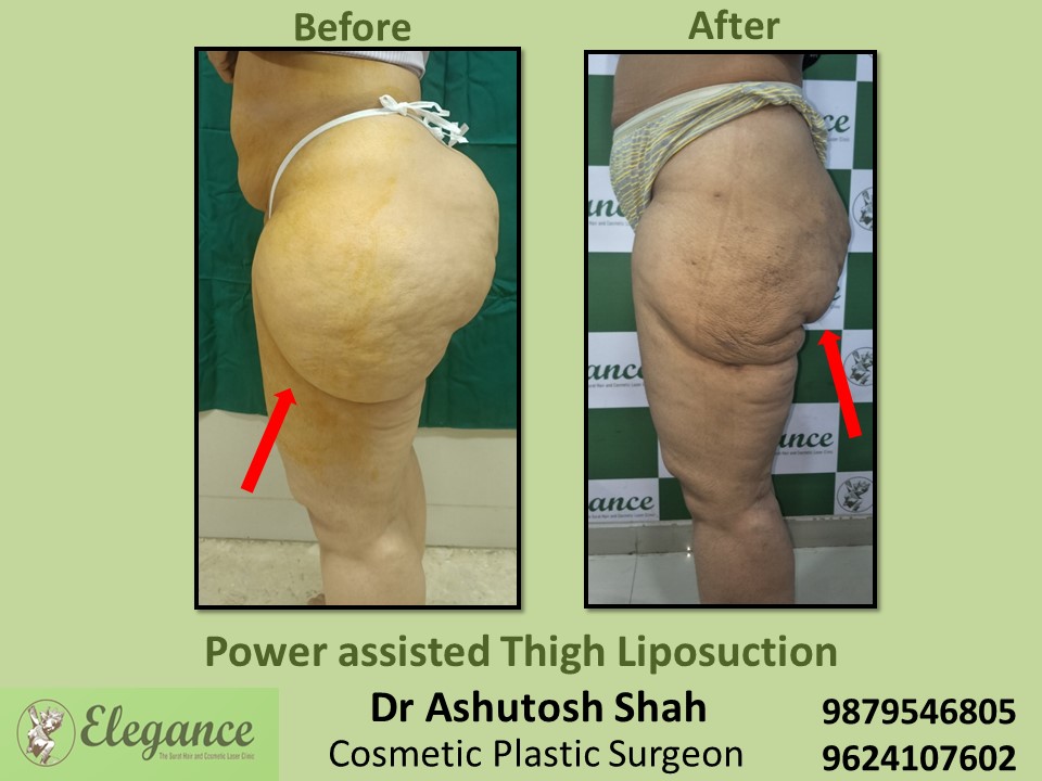 Liposuction-Thigh Fat Reduction Before and After Result In Surat, Ankleshwar,  Vapi.