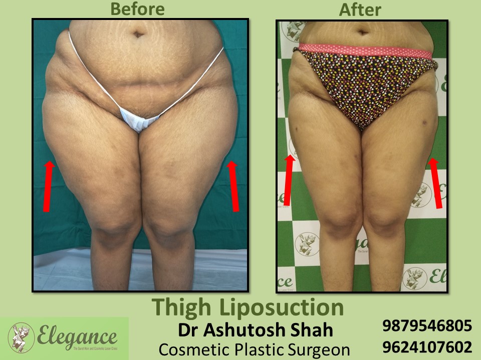 Liposuction-Thigh Fat Reduction Treatment  In Bharuch, Navsari, Vapi, Surat.