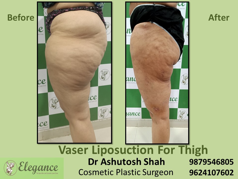 Liposuction-Thigh Fat Removal Cost  In Vadodara, Bharuch, Vapi, Surat.