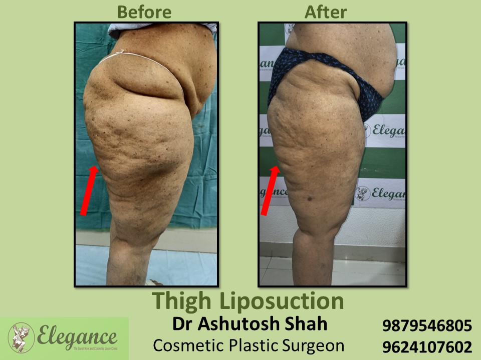 Liposuction-Thigh Fat Removal Treatment Techniques In Surat, Vadodara, Navsari.