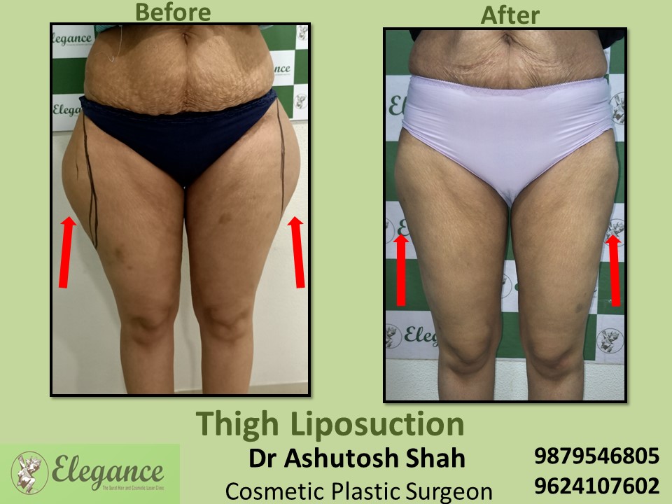 Liposuction-Treatment for Thigh Fat Reduction In Surat, Vapi, Bharuch.
