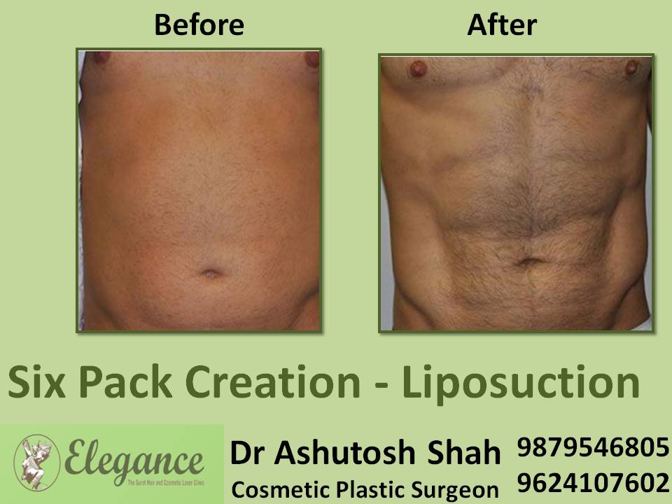 Six Pack Abs Before And After In Surat, Gujarat, India