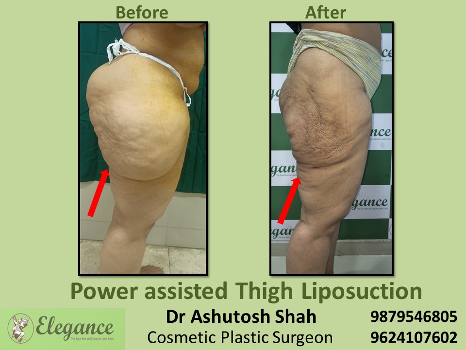 Thighs fat decrease surgery in Piplod, Vesu, Dumas, Surat