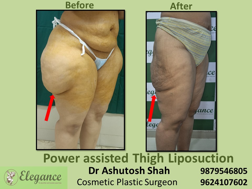 Butt and Thighs Fat Reduction treatment in Vadodara, Surat