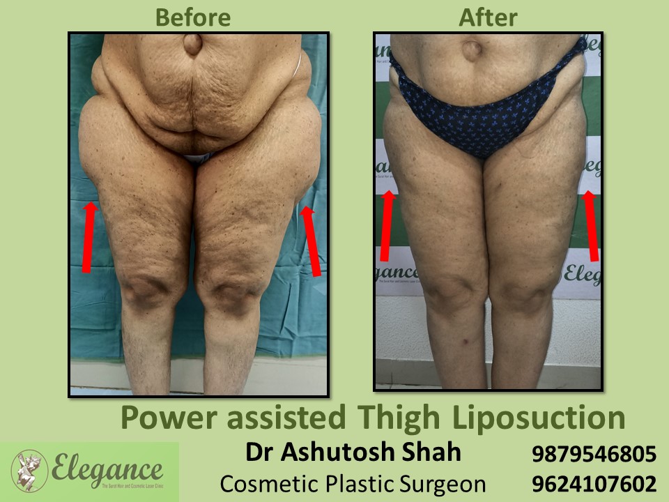 Low cost surgery for extra fat reduction from thighs and hips in Awthaline, Katargam, Surat