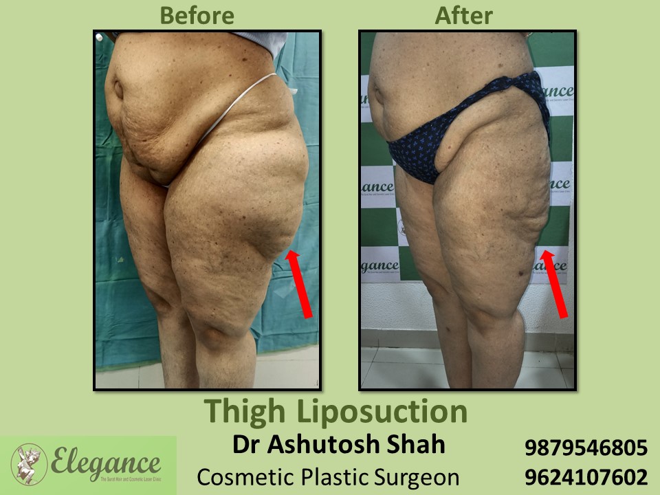 Hip and thighs Reduction of fat treatment in Bharuch, Vapi, Kim, Surat
