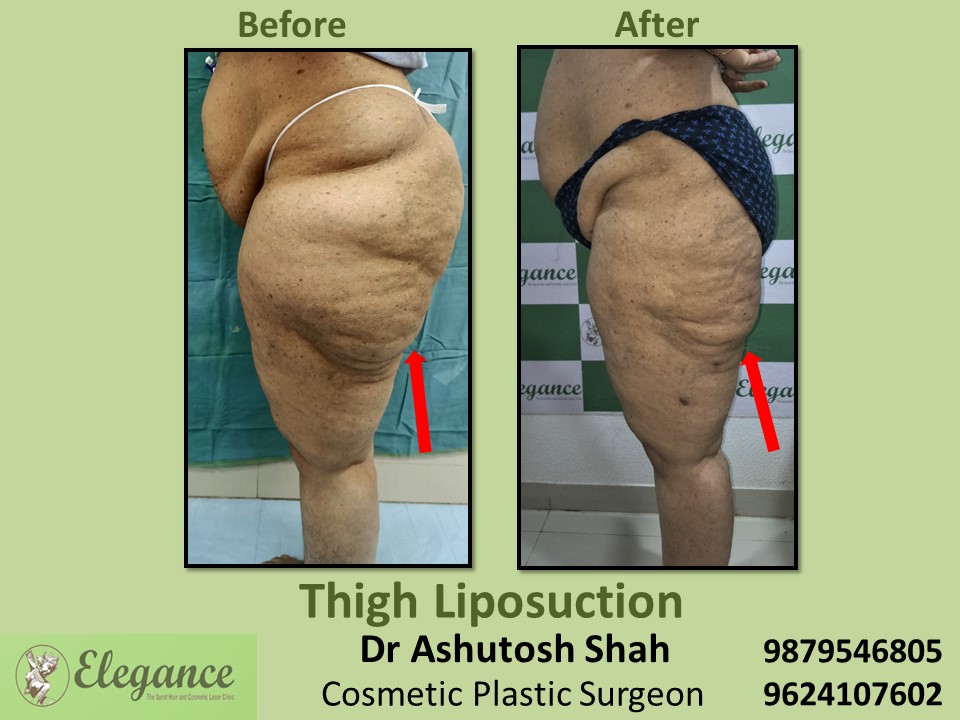 Removal of extra fat from butt and thighs in Ankleshwar, Navsari, Surat