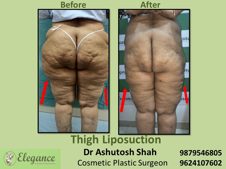 Low cost Liposuction for Hip & Thighs in Valsad, Bardoli, Surat