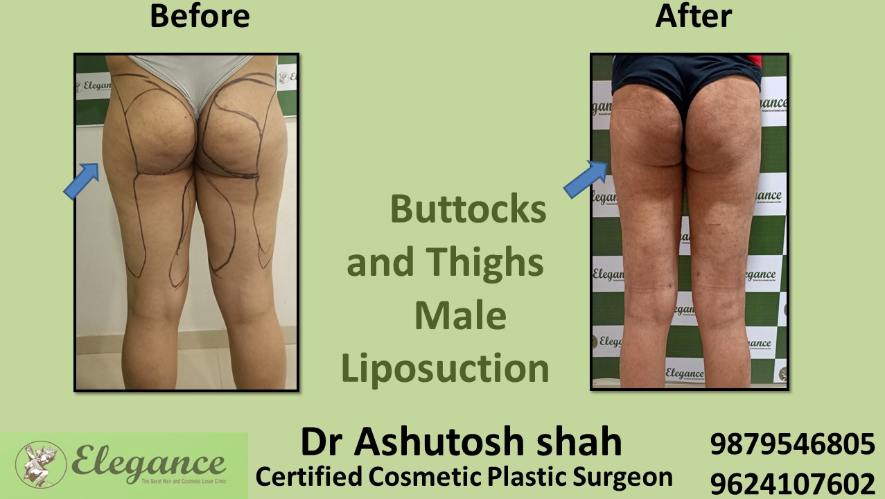 Hip fat removal Surgery Vesu, Sachin, Surat