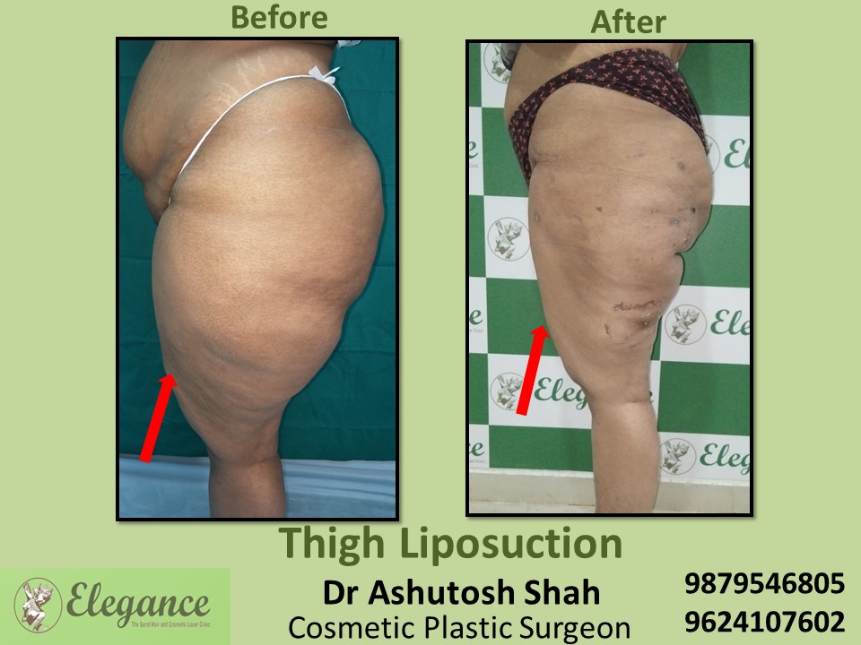 Fat removal or liposuction from thighs and hip in Adajan, Vesu, Surat
