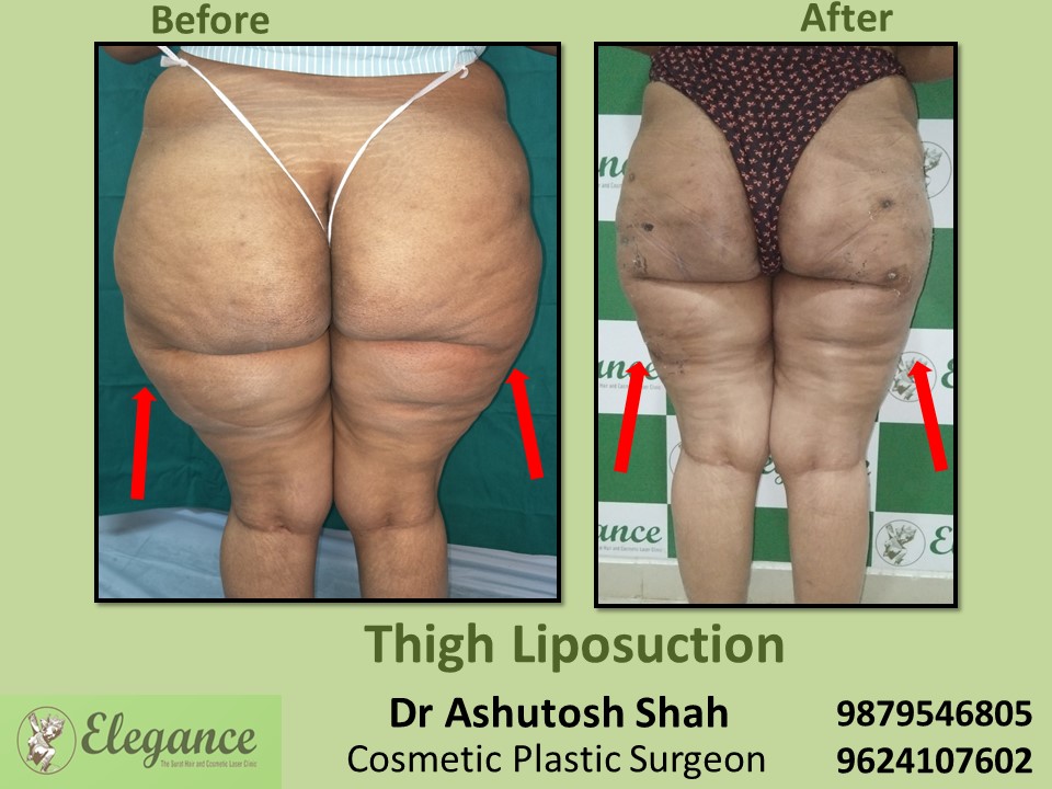 Removing extra Fat from Thighs & Butt in Vapi, Valsad, Surat