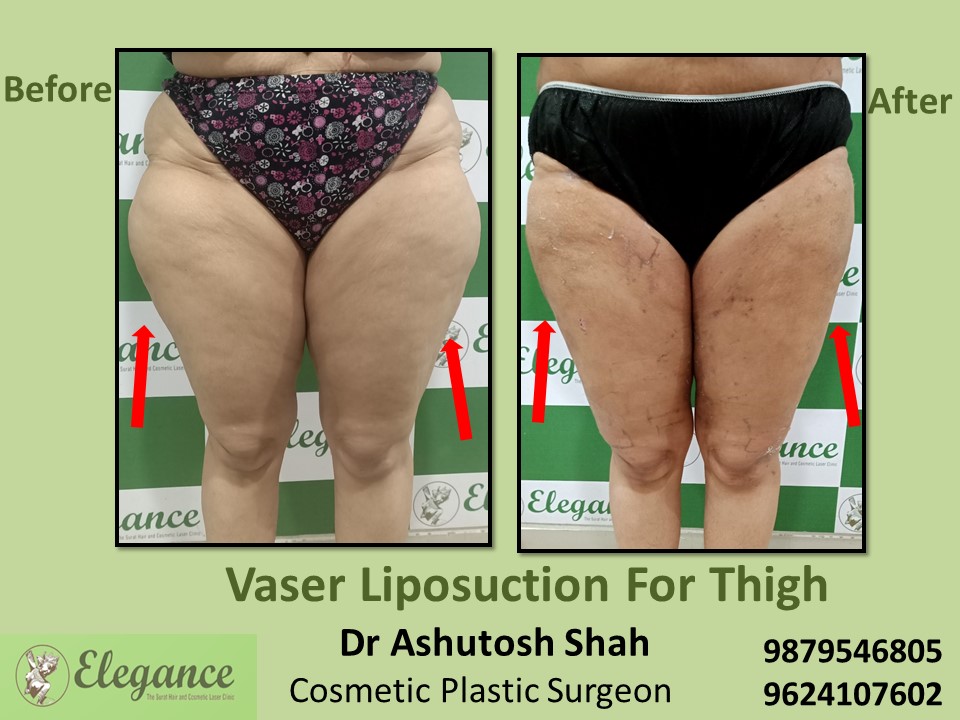 Best Fat removal Treatment in Piplod, Aathwaline, Vesu, Surat