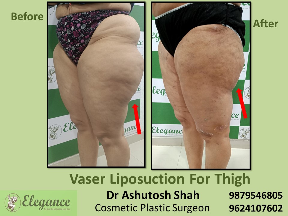 Liposuction surgery for Thighs and Hips in Kim, Kosamba, Surat