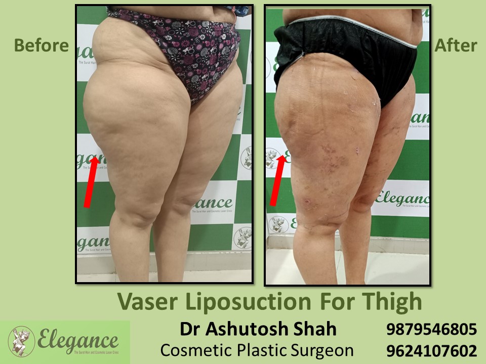 Extra Fat removing from Hips & Thighs / legs in Adajan, Sachin, Surat
