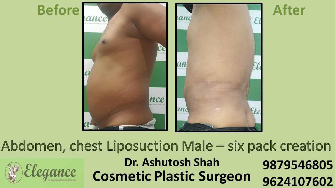 Male Abdomen Liposuction in Valsad, Vapi, Surat