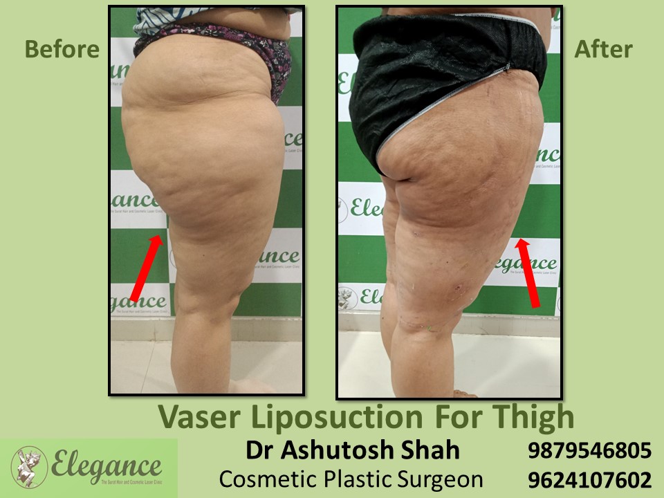 Hips and Thighs fat reduction process in Adajan, Hazira, Varachha, Surat