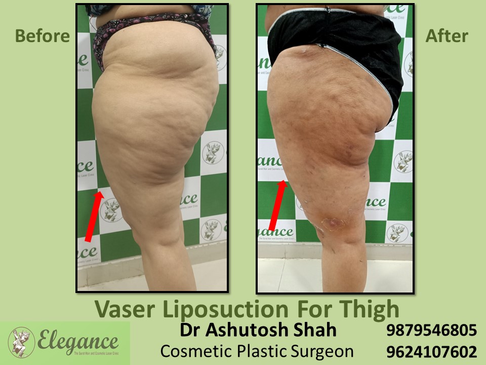 Minimum cost of fat reduction from thighs and hips in Navsari, Suart