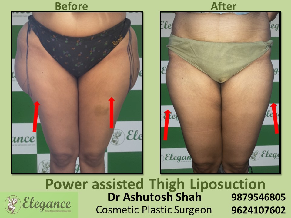 Fat loosing Surgery from thighs and hips in Rajkot, Ahemedabad, Surat