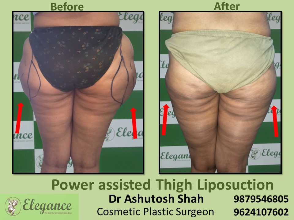 Decrease Extra Fat from hips and thighs in Bharuch, Baroda, Kim, Surat