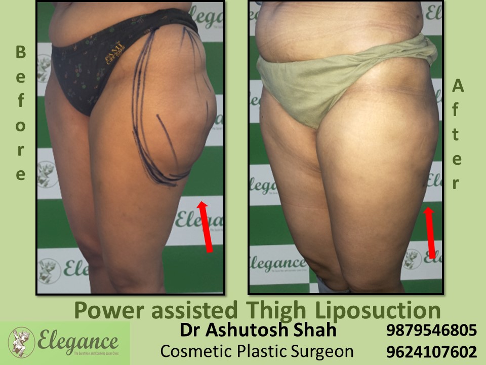 Thighs & Hips Fat Reduction at low cost in Kosamba, Kadodra, Surat