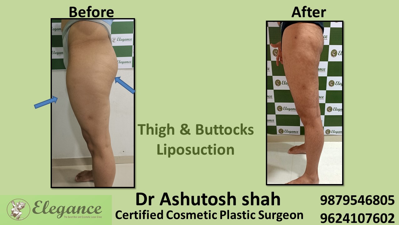 Extra Fat removal treatment in Adajan, Surat