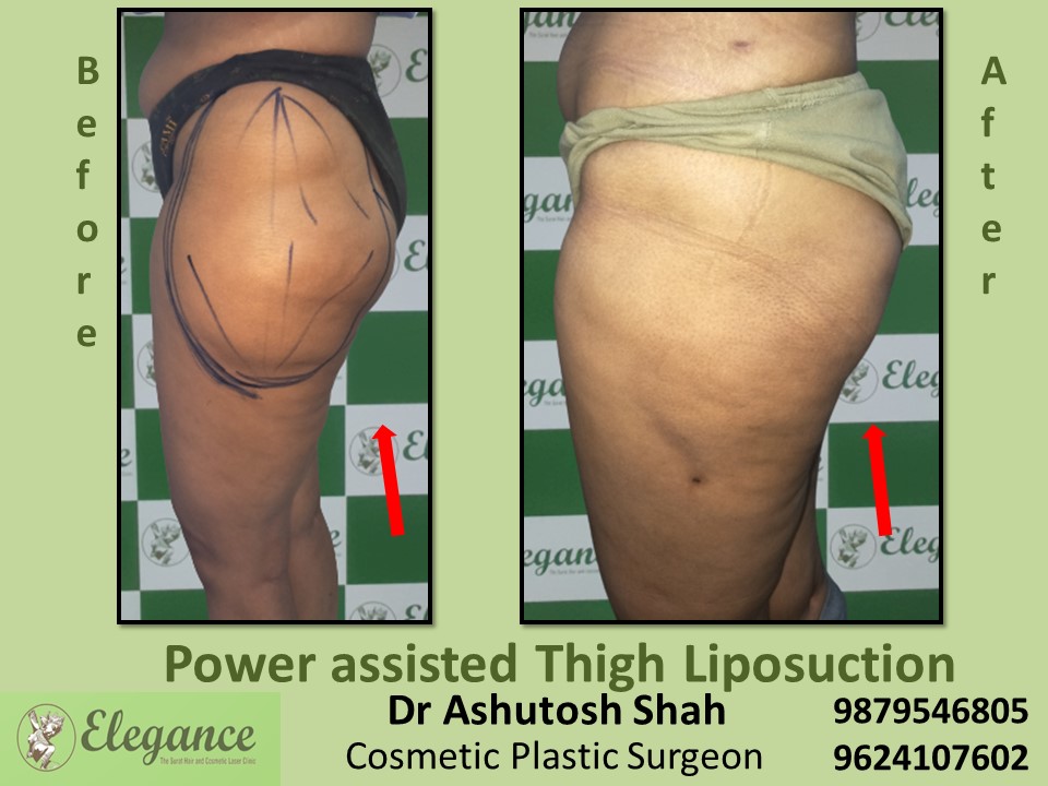 Hips Extra Fat Reduction Treatment in Ahemedabad, Baroda, Surat