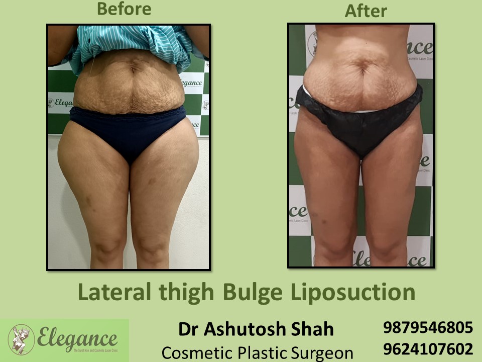 Legs Liposuction treatment in Ghod Dod road, Citylight, Athwalines, Surat