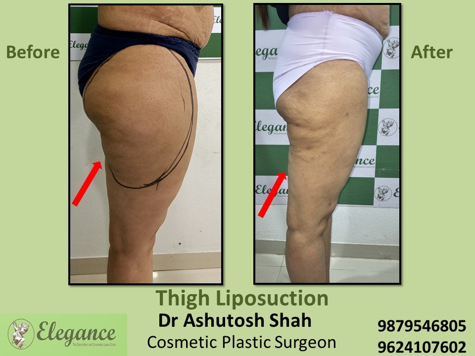 Thighs & Hips Surgery for Extra Fat in Dumas road, Sachin, Olpad, Surat