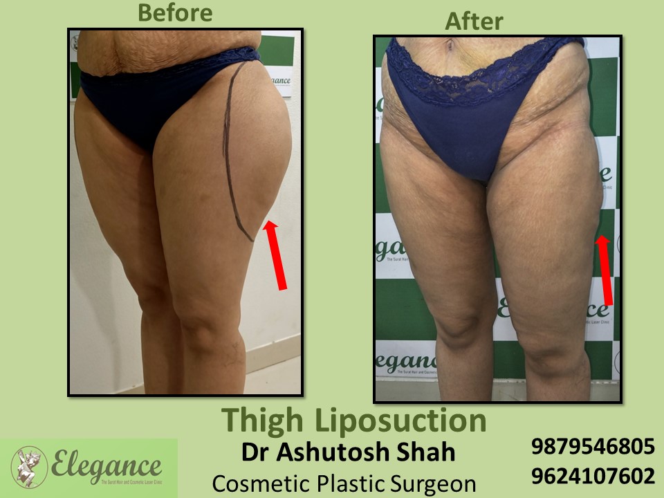 Liposuction Treatment for Hips & Thighs in Citylight, Varachha, Vesu, Surat