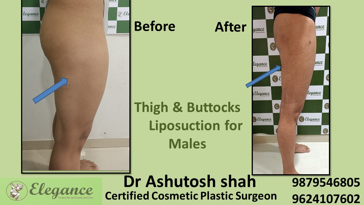 Thighs fat removal treatment in Olpad, Kim, Kosamba, Surat
