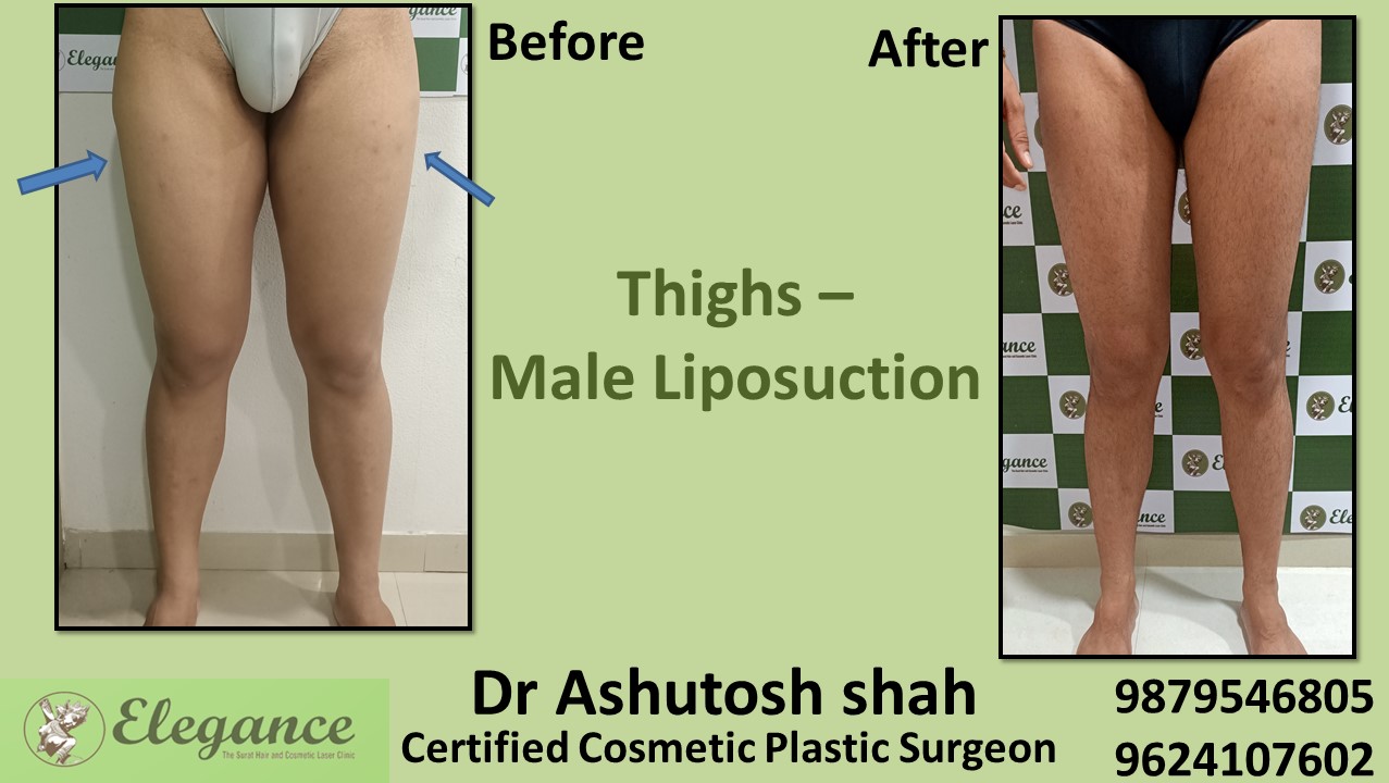 Extra Fat Reduction Surgery for Male in Bharuch, Vapi, Surat