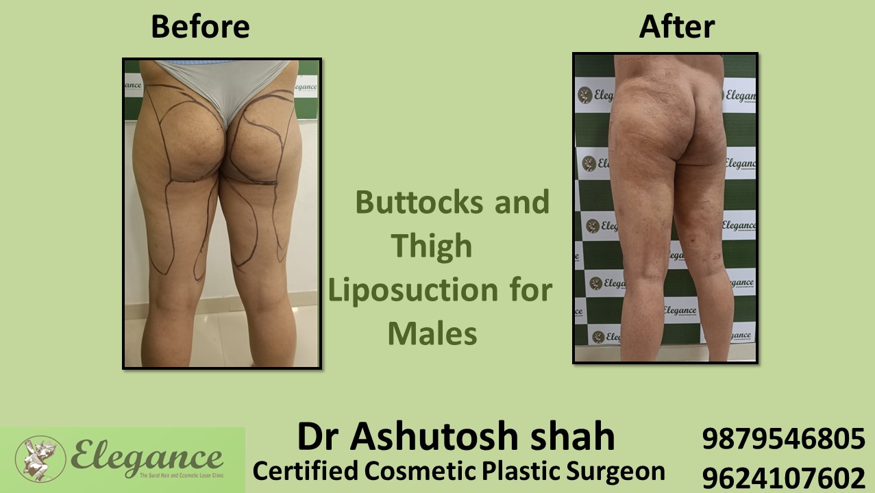 Fat Reduction Surgery at low cost in Surat