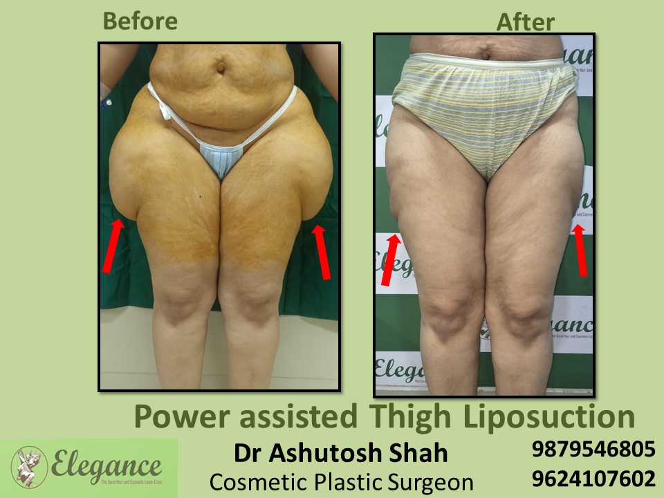 Low cost extra fat removal from hips and thighs in Vesu, Adajan, Surat