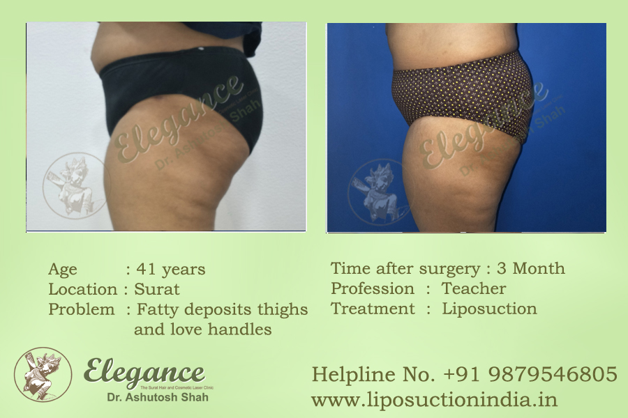 Liposuction in Surat, Gujarat, india