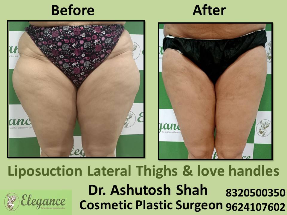 Liposuction Lateral Thighs And Love Handle, Cosmetic Plastic Surgery, Tapi, Valsad, Dang, Surat, Gujarat.