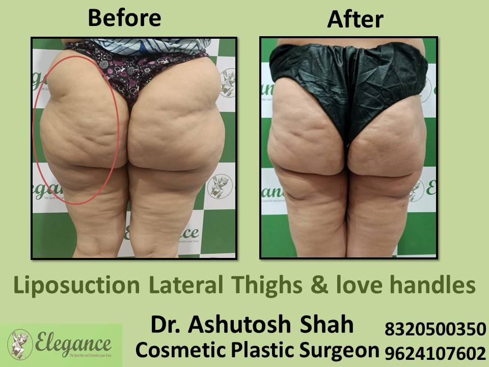 Liposuction Lateral Thighs And Love Handle, Fat Removing Surgery, Bharuch, Navsari, Tapi, Surat, Gujarat.