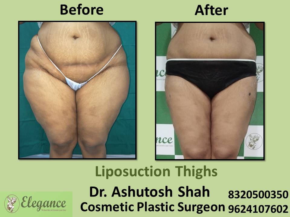 Liposuction Thighs, Cosmetic Plastic Surgery, Tapi, Valsad, Dang, Surat, Gujarat.