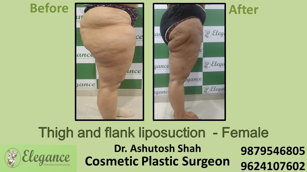 Thigh and Flank Liposuction in Kim, Surat