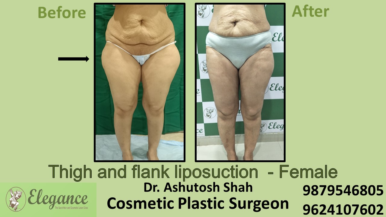 Thigh and Flank Liposuction in Kim, Kosamba, Surat