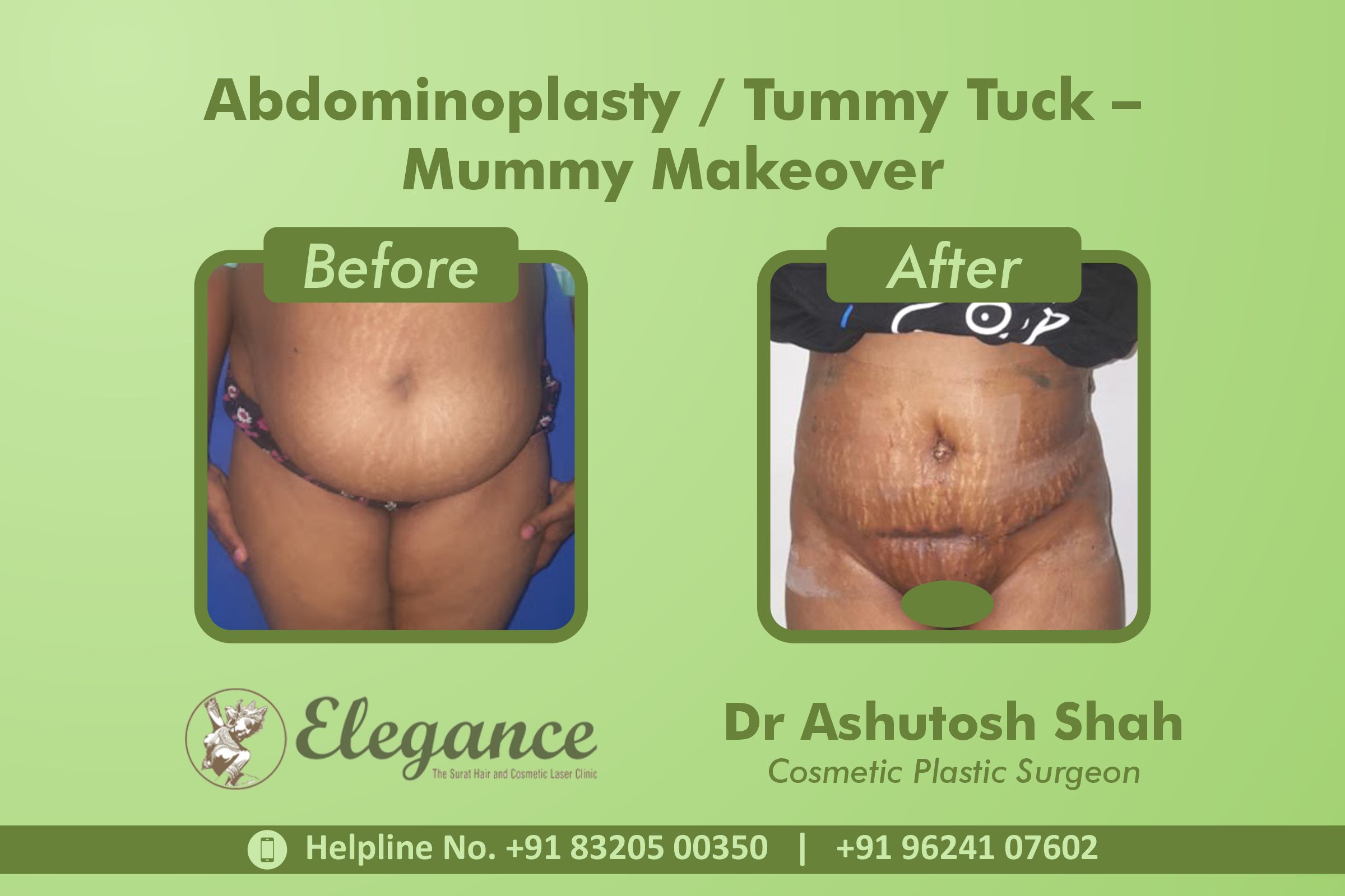 Abdominoplasty, TummyTuck- Mummy Makeover, Vesu, Surat