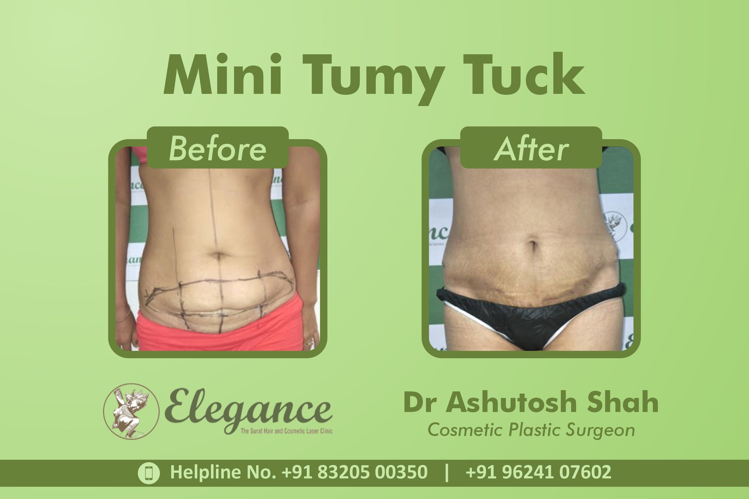 Mini Tummy Tuck Surgery, Surat