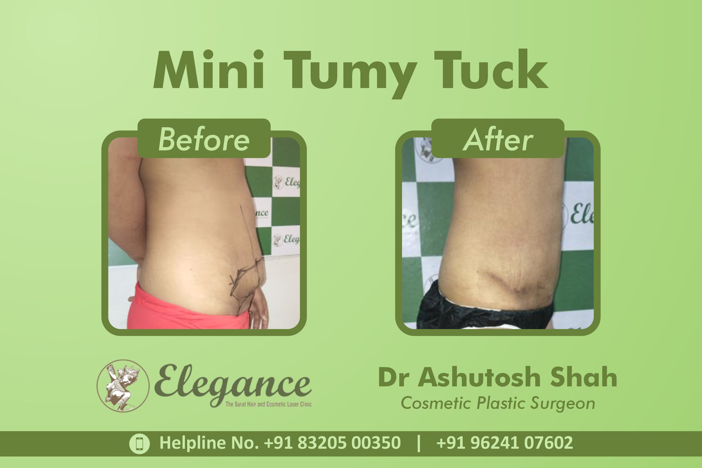Mini Tummy Tuck Surgery, Adajan, Surat