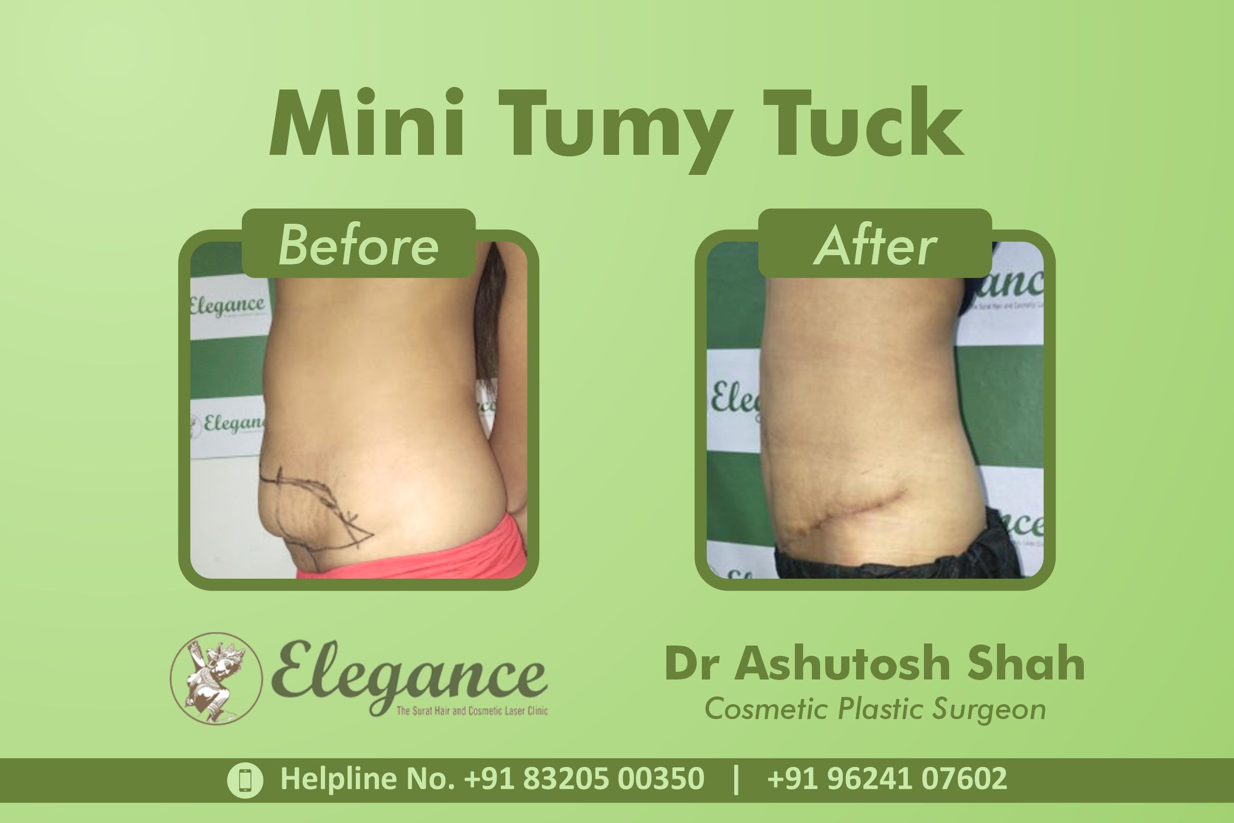 Mini Tummy Tuck Surgery, Rander, Surat