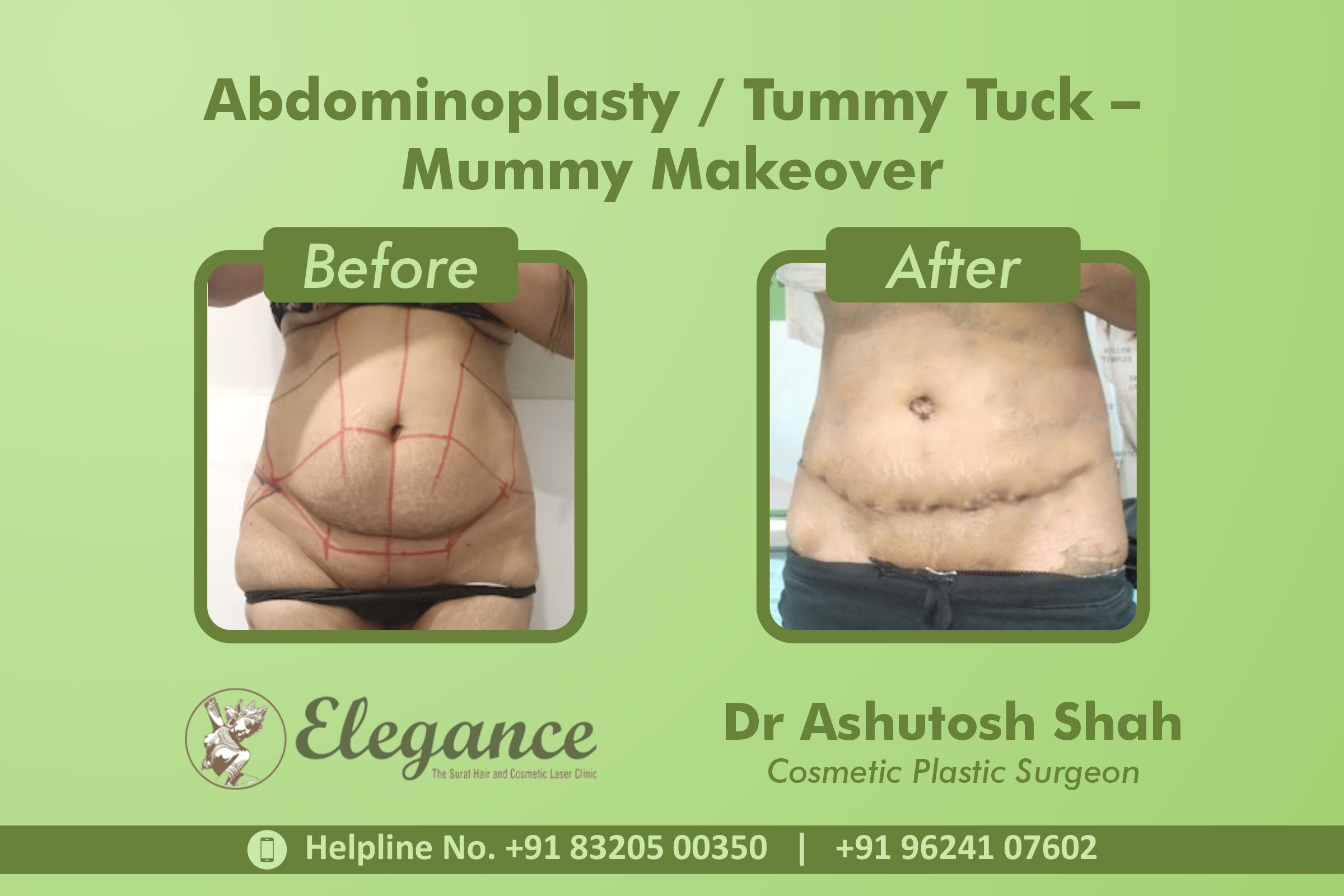 Abdominoplasty, Tummy Tuck Surgery, Mummy Makeover in Dumas