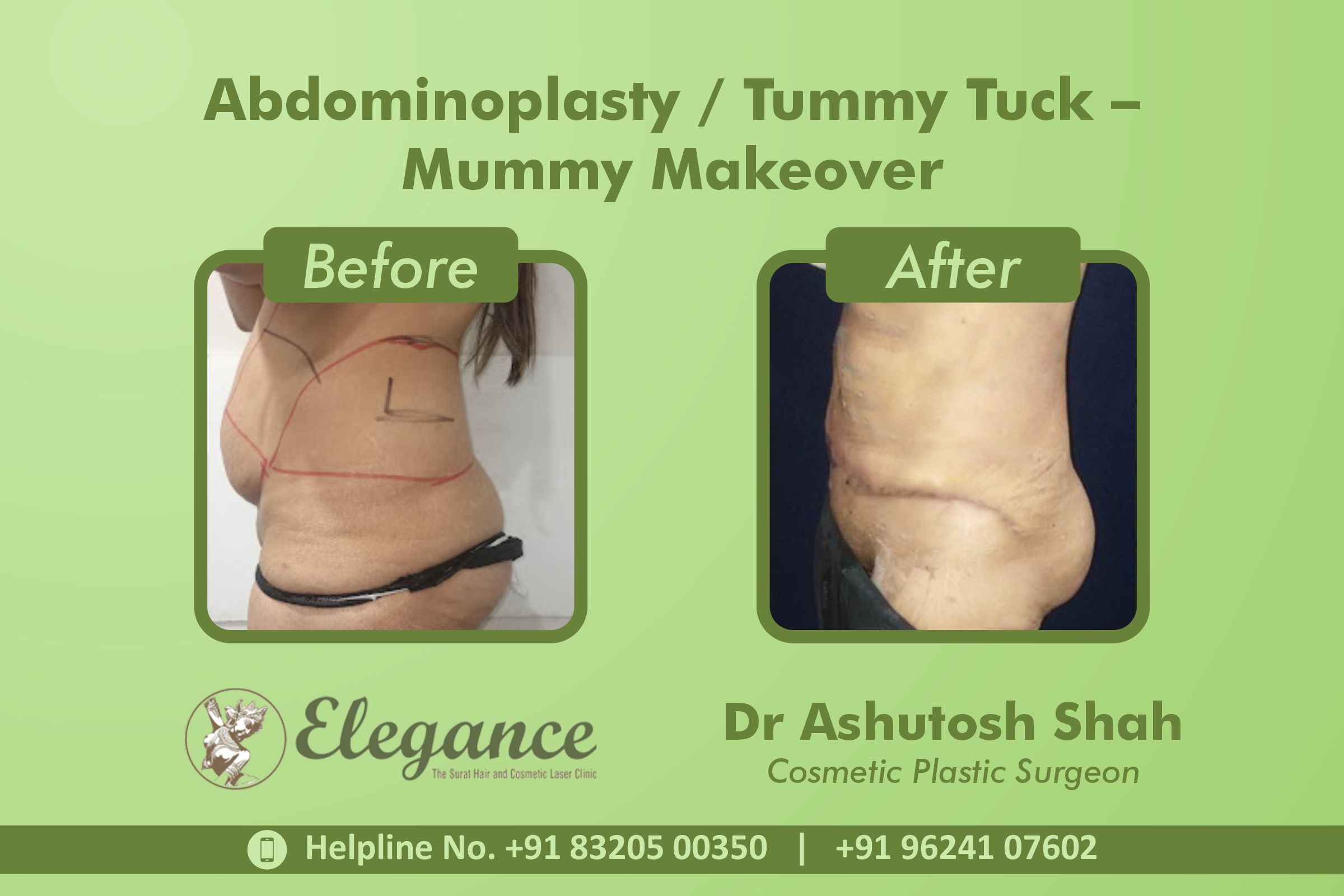 Abdominoplasty, Tummy Tuck Surgery, Mummy Makeover in Vesu, Dumas, Surat