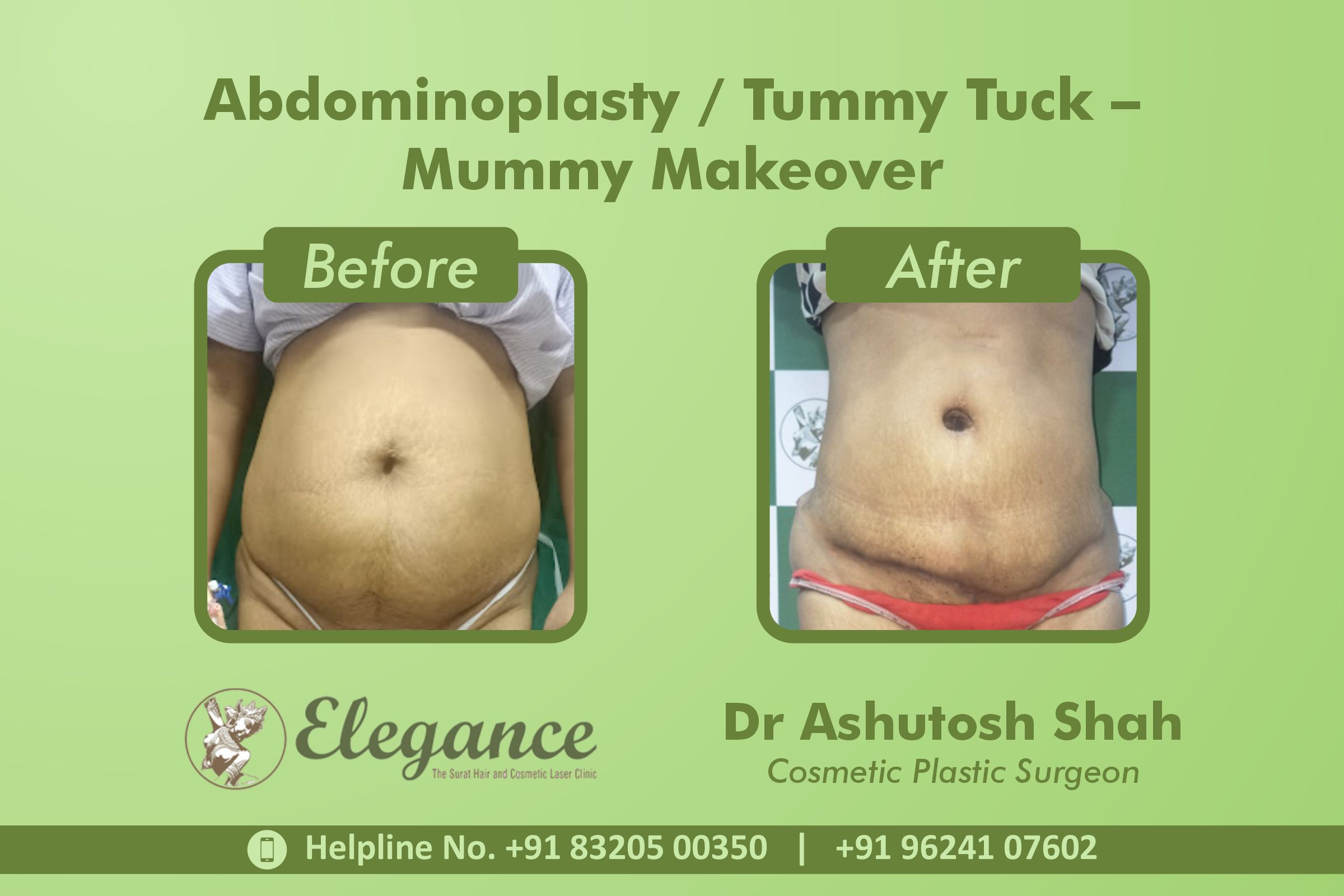 Abdominoplasty, Tummy Tuck Surgery, Mummy Makeover in Surat
