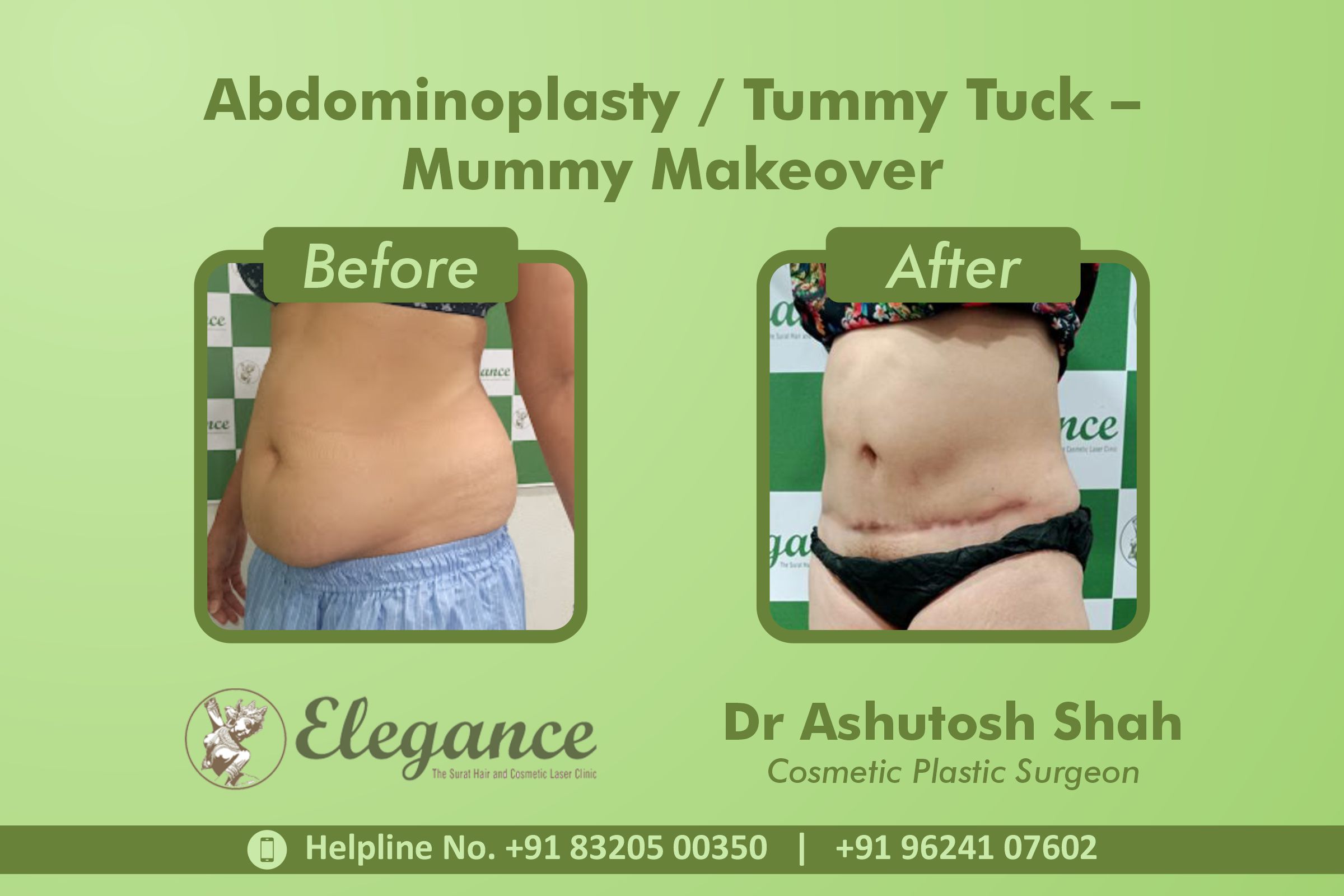 Abdominoplasty, Tummy Tuck Surgery, Mummy Makeover in Udhna, Surat